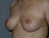 Patient # 82406 After Photo # 4